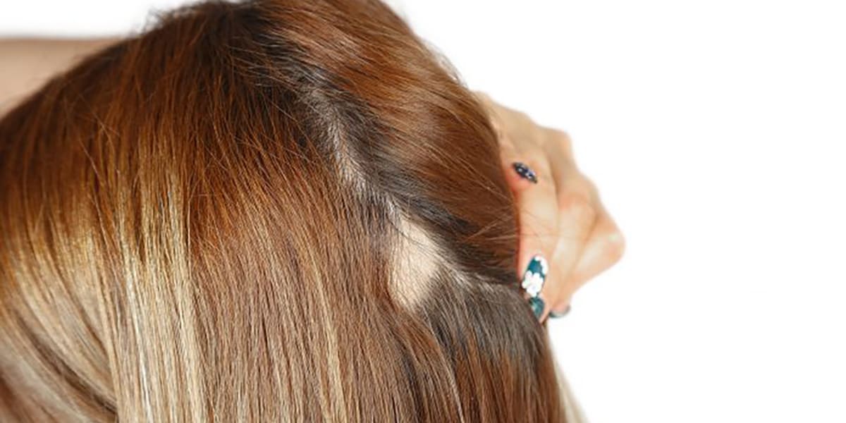 Alopécie : Notre sélection de Perruques adaptées pour vous